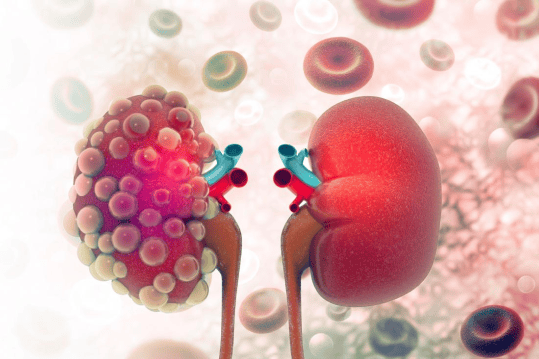 kidney_disease
