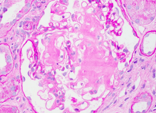 Chronic Kidney Disease Management: Enhancing Kidney Health