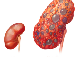 Hemodialysis and Peritoneal Dialysis: Comprehensive Renal 
                Replacement Therapies